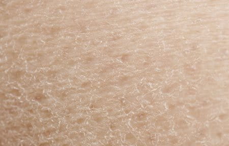 Dry Skin