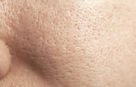 Oily Skin