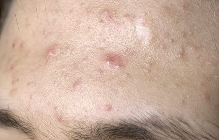 Sensitive Skin